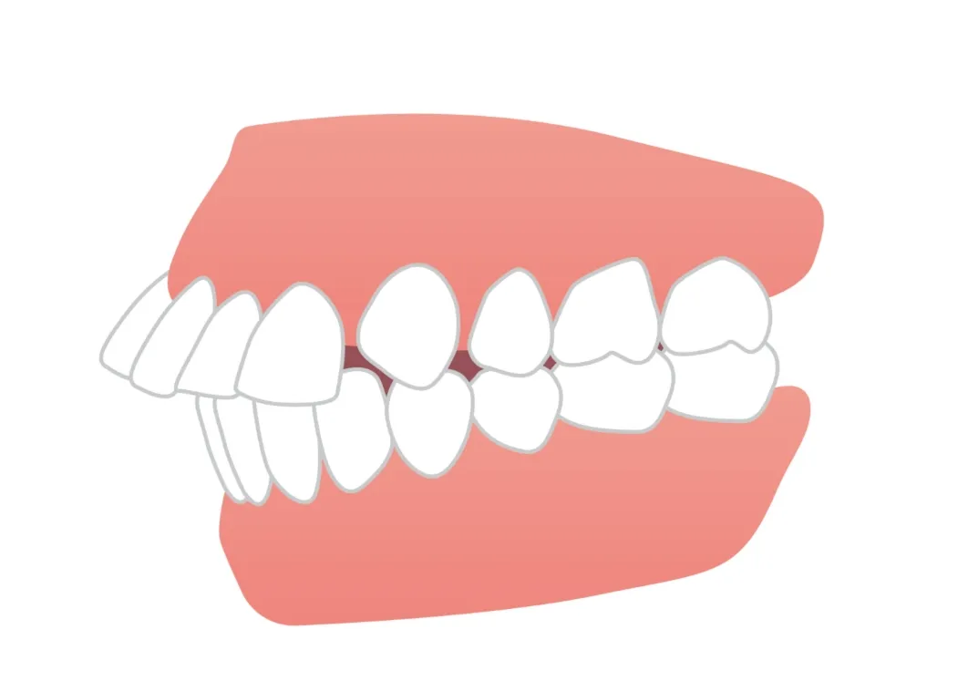 出っ歯（上顎前突）