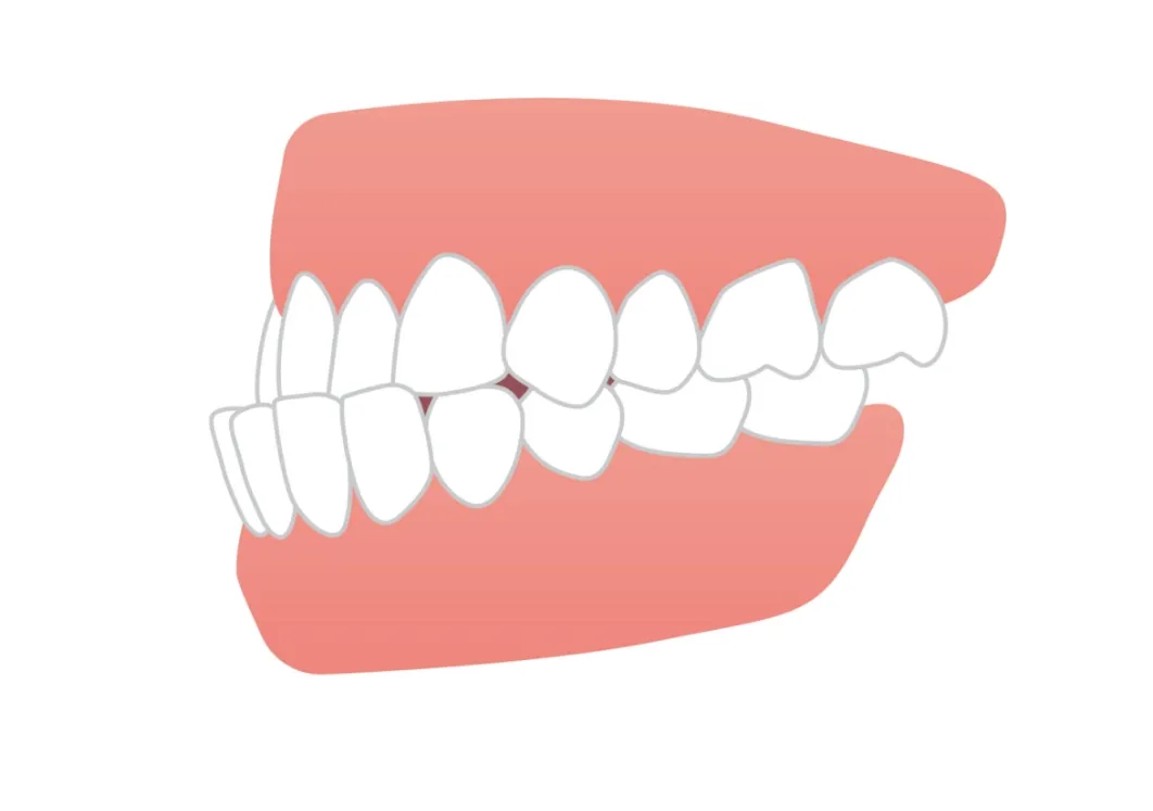 受け口（下顎前突）