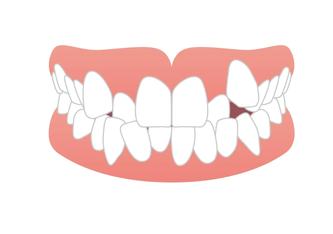 八重歯・乱ぐい歯（叢生）