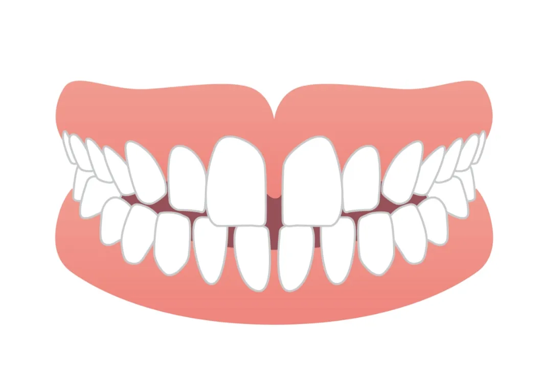 すきっ歯（空隙歯列）