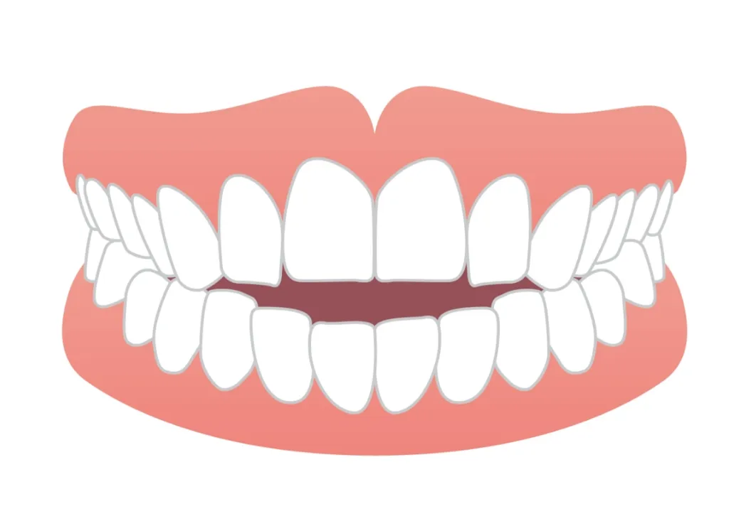 歯が閉じない（開咬）