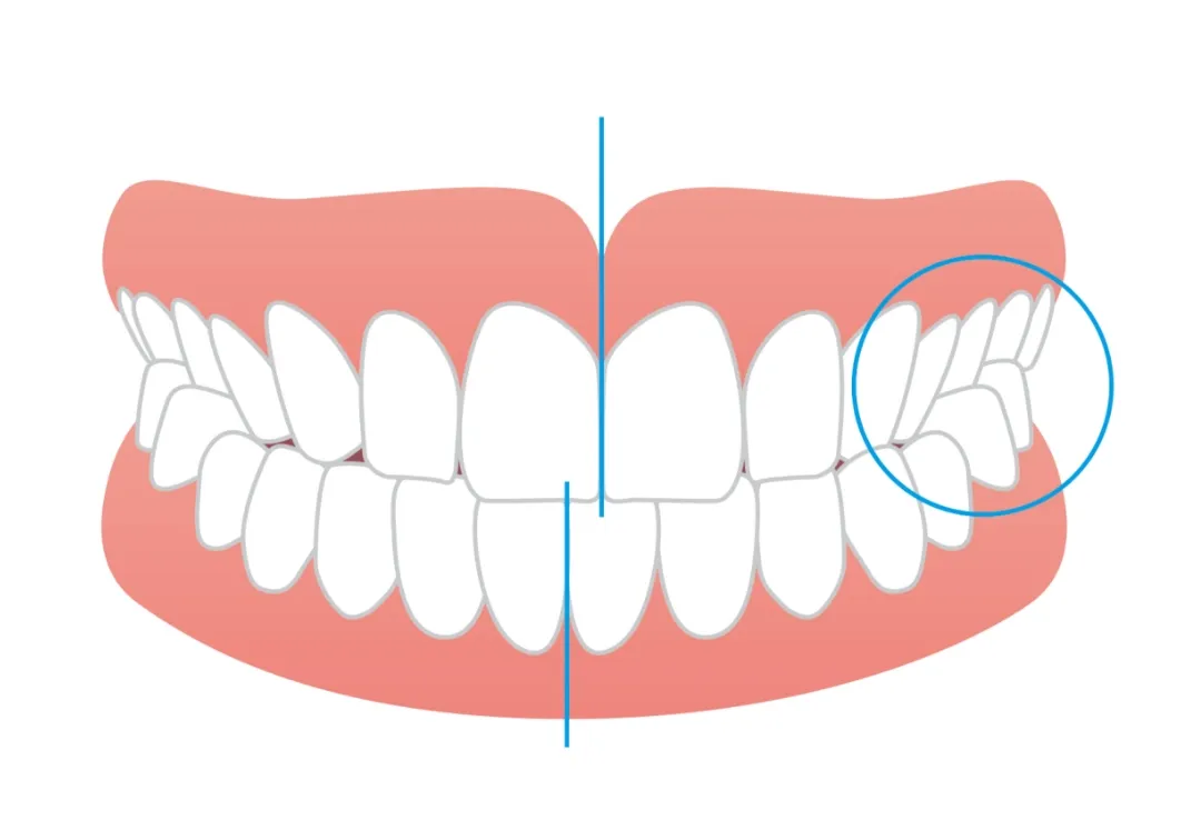 噛み合わせのズレや交叉咬合