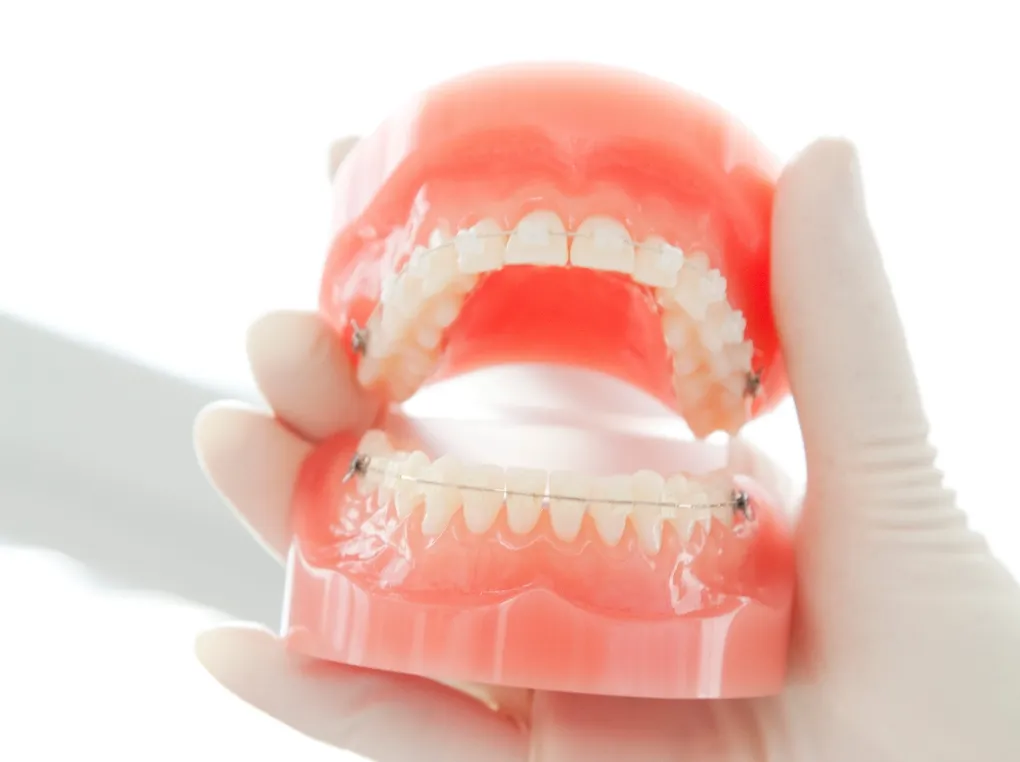 目立ちにくいワイヤー矯正（審美ブラケット）