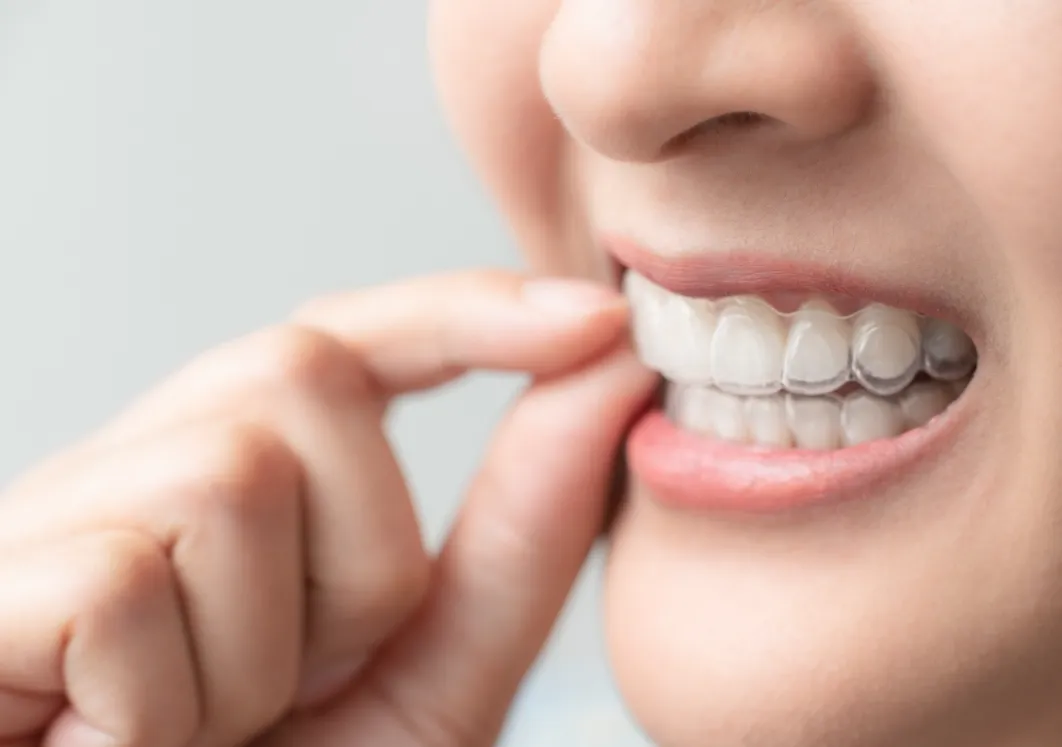 装置が透明で矯正中もあまり目立たない