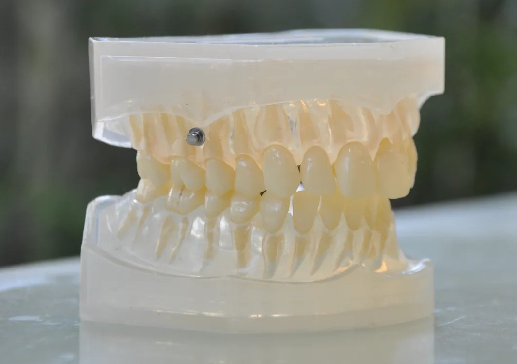 補助矯正装置（アンカースクリュー等）との併用