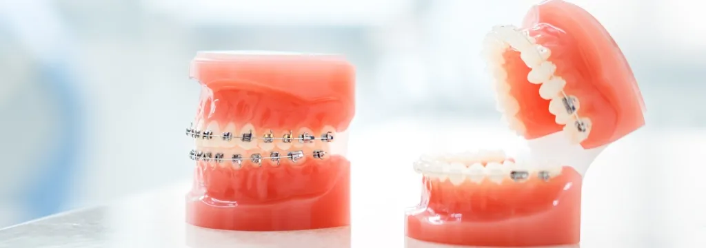 ワイヤー矯正（マルチブラケット装置）